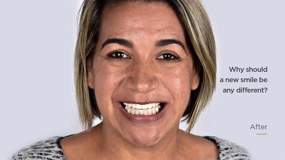 Dental_Implants_After_Photo_EN
