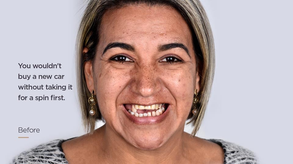 Dental_Implants_Before_Photo_EN